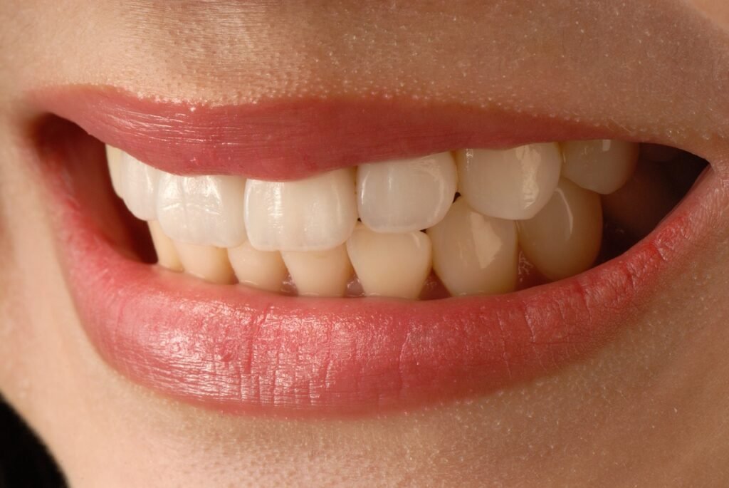 العدسات التجميلية للأسنان فينير الاسنان الثابتة