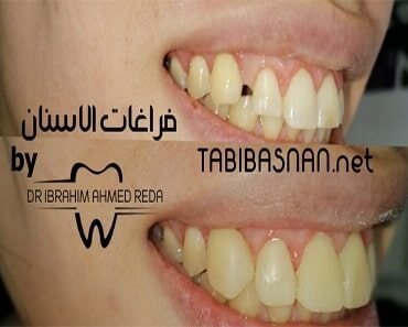 الفراغات بين الأسنان الأمامية | علاج الفلجة بين الأسنان الأمامية