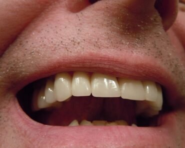 تركيبات الأسنان الثابتة – سبعة اشياء يجب ان تأخذها في اعتبارك قبل عمل تركيبات الاسنان.