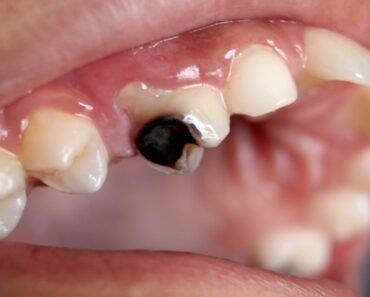 ما هو تسوس الأسنان؟ أعراضه؟ وطرق العلاج.