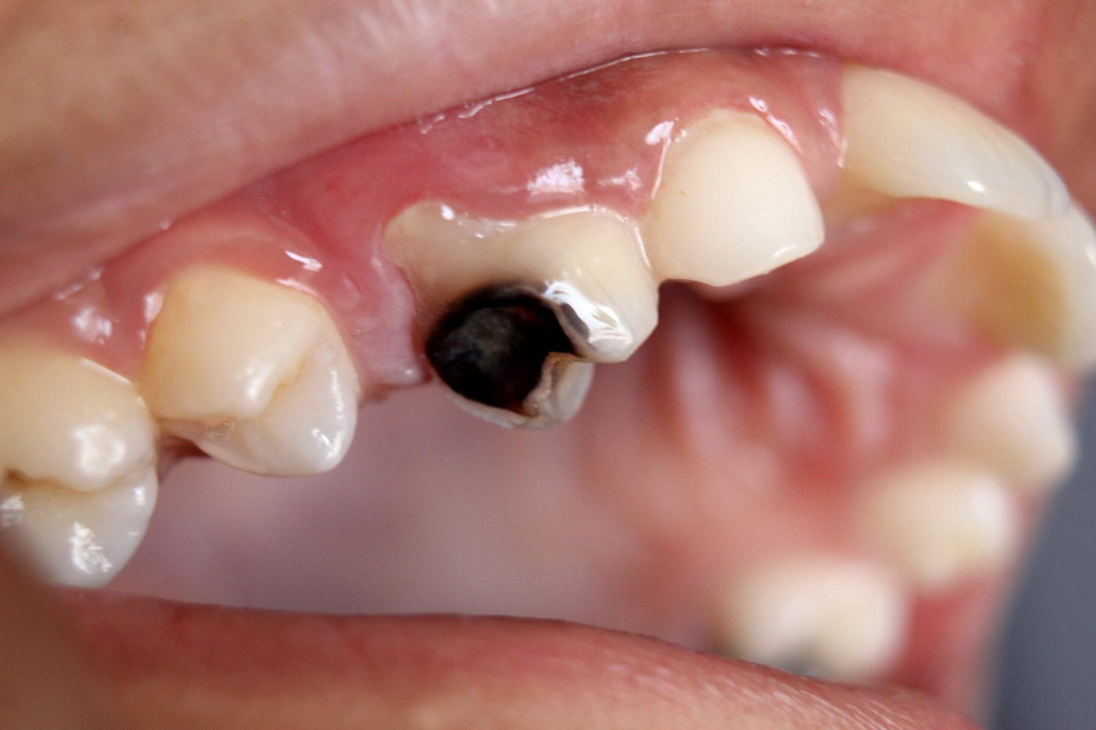 تسوس الأسنان وأعراضه وطرق علاجه