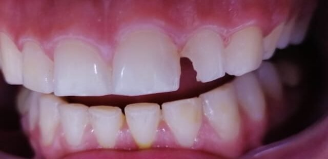 class 4 cavity كسر في الاسنان الامامية