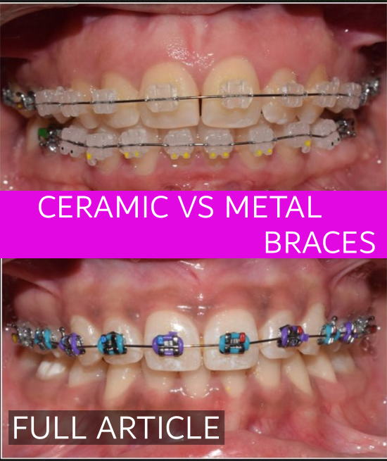 Clear Braces vs. Metal Braces