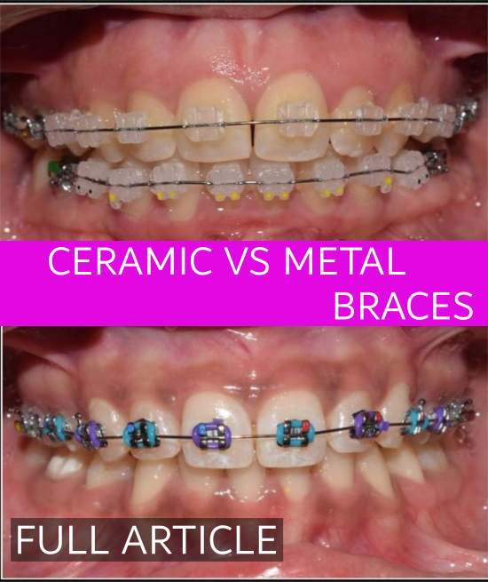 iDENTical Half Metal and Half Ceramic Brackets Orthodontics Model