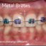 Clear braces vs Metal Braces.