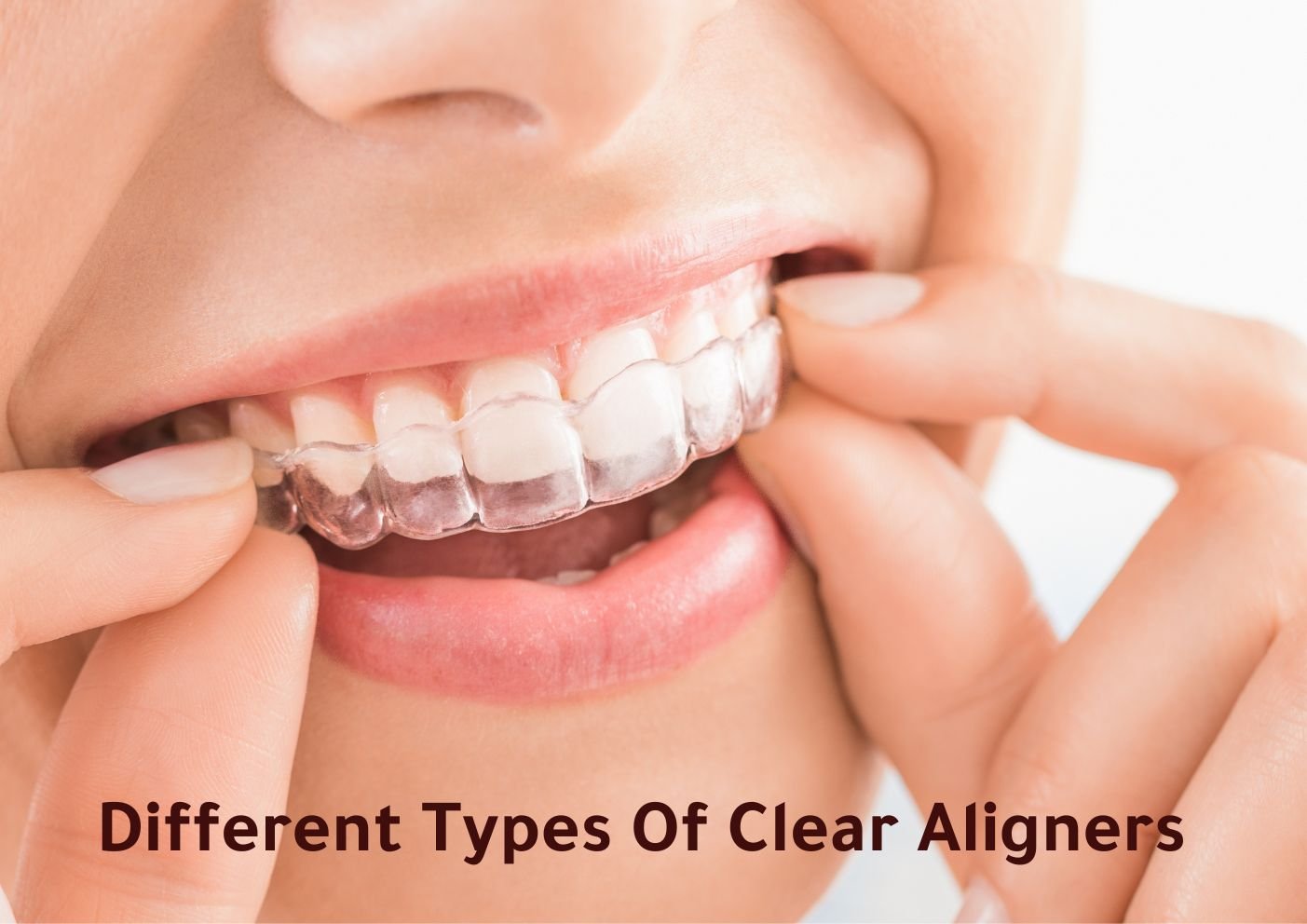 different types of clear aligners