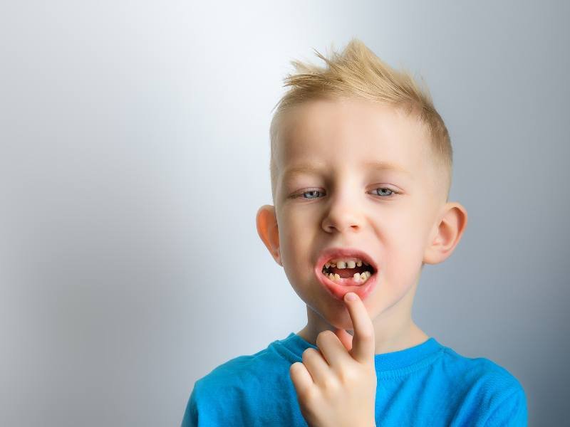 تسوس الاسنان اللبنية عن الاطفال
