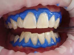 يعتبر تبييض الأسنان بالليزر أكثر فاعلية من التبييض المنزلي