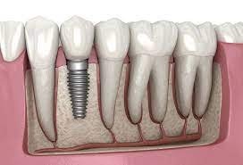 تعتبر زراعة الأسنان خيار مثالي لتعويض الأسنان المفقودة